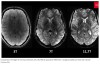 Comparaison d’images de cerveau obtenues avec des IRM de puissance différente. L’image produite par Iseult est à droite.
