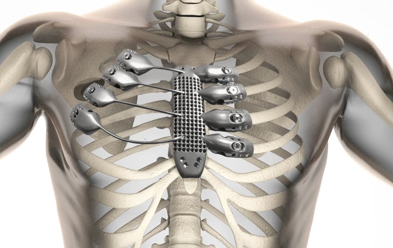 3d-printed-sternum-illustration.jpg