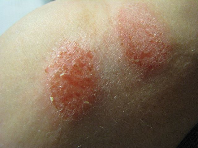 Eczema-rouge.jpg