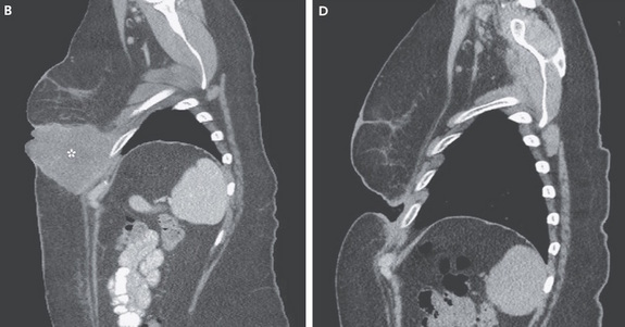 Melanoma-CT-Scan.jpg