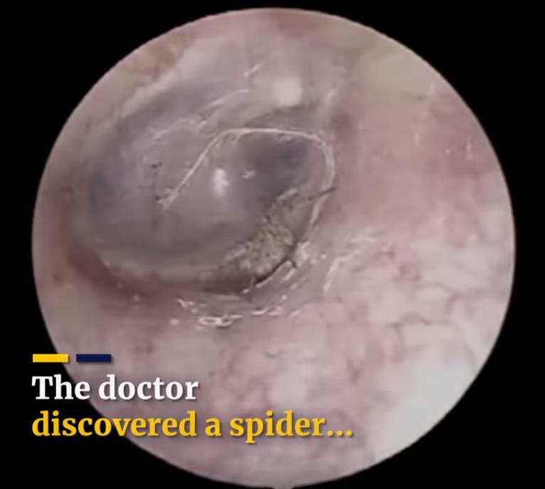 iflscience.com health-and-medicine weird-crawling-sensation-inside-mans-head-turns-out-to-be-a-spider-spinning-a-web-in-his-ear.jpg