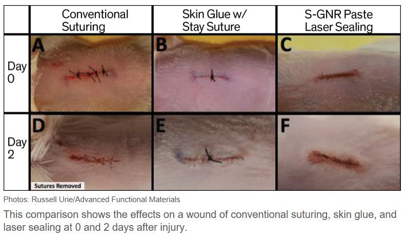 spectrum.ieee.org the-human-os biomedical devices star-treklike-tech-seals-wounds-with-a-laser 2.jpg