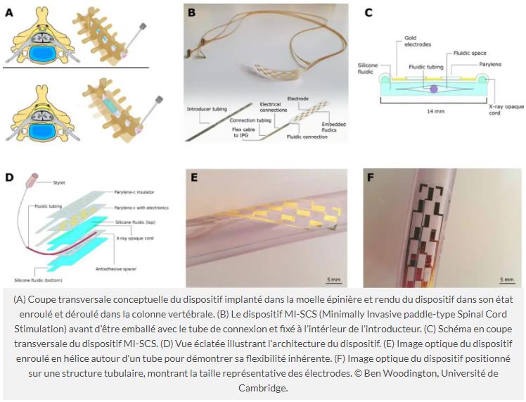 trustmyscience.com implant-gonflable-injecte-dans-colonne-vertebrale-pourrait-soulager-douleur-chronique.jpg