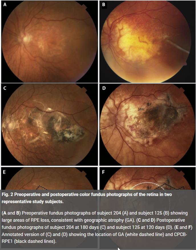 trustmyscience.com implants-retiniens-pour-arreter-cecite-liee-age.jpg