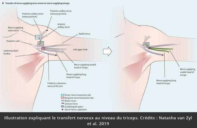 trustmyscience.com transfert-nerfs-restaure-mobilite-mains-coudes-chez-tetraplegiques.jpg